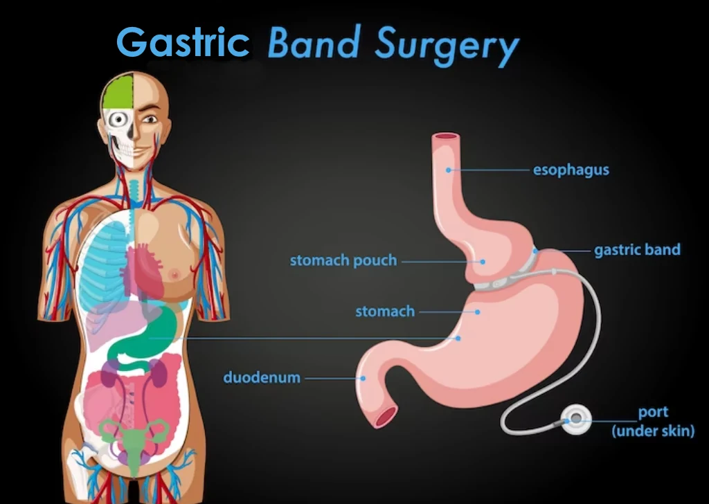 Gastric Band in Turkey – What to Know